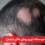 ریزش مو سکه ای