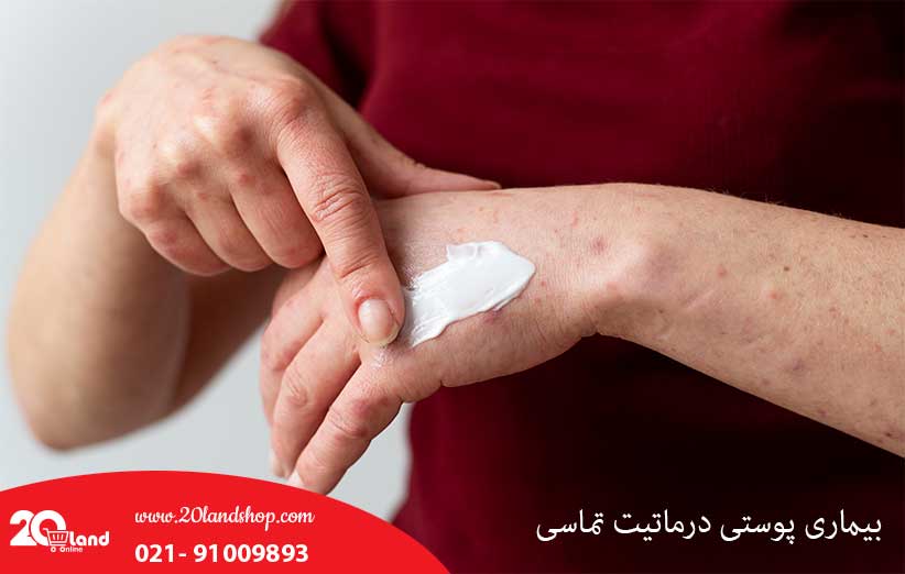 بیماری پوستی درماتیت تماسی