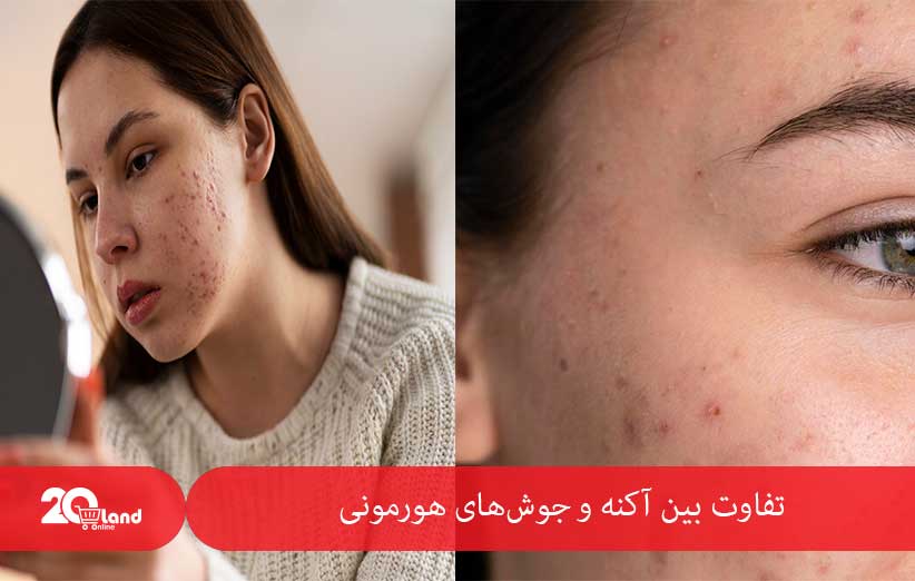 تفاوت بین آکنه و جوش‌های هورمونی