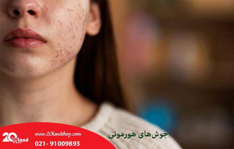 جوشهای هورمونی