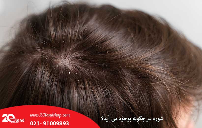 شوره سر چگونه بوجود می آید