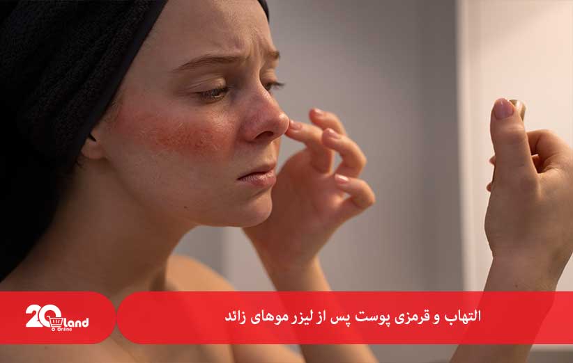 قرمزی پوست پس از لیزر موهای زائد
